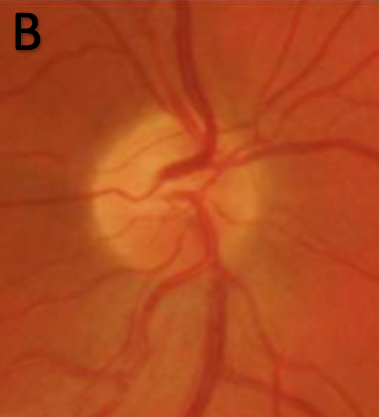 Non-arteritic Ischemic Optic Neuropathy