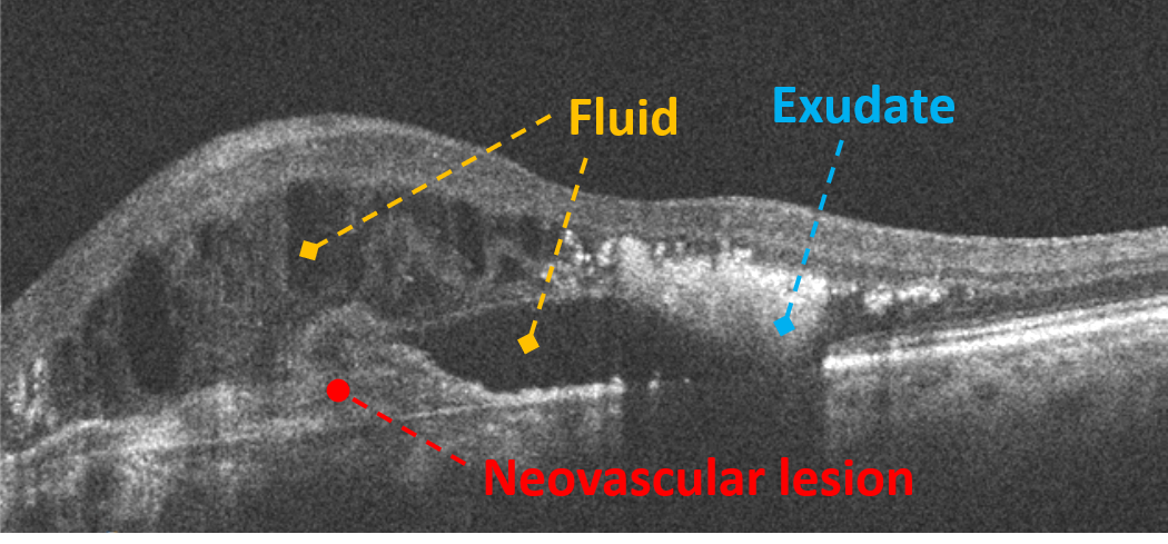 Exudative Macular Neovascularization