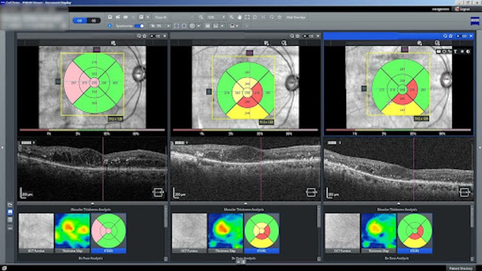ETDRS grid showing non-proliferative diabetic retinopathy