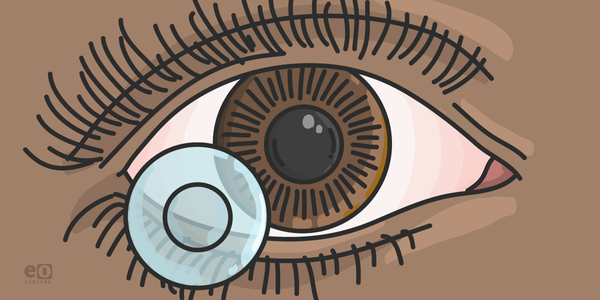 Treating Corneal Dellen with Bandage Contact Lenses