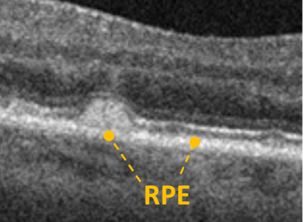 SDD with RPE under lesion