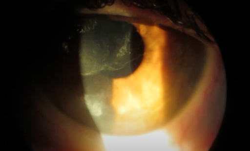 https://covalentcareers3.s3.amazonaws.com/media/original_images/neurotrophic_cornea_with_chronic_dryness.png