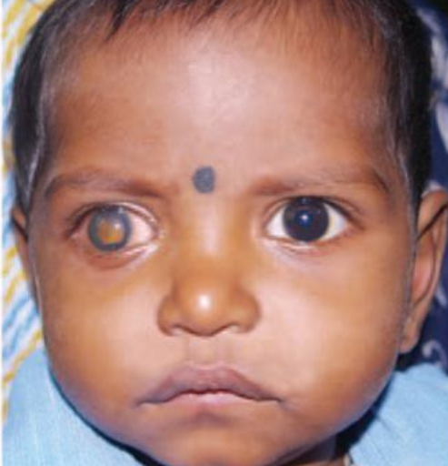 https://covalentcareers3.s3.amazonaws.com/media/original_images/retinoblastoma.png